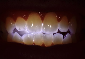 LiteWing Transillumination Device - Dental Photography Tool